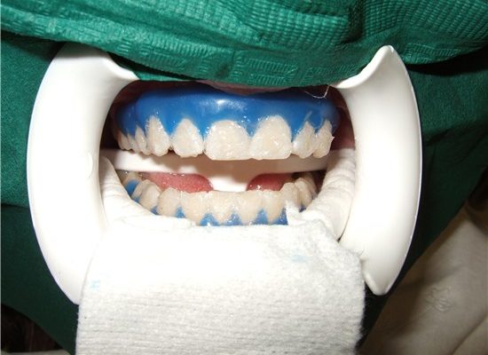 tooth-whitening_2