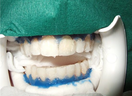 tooth-whitening_3